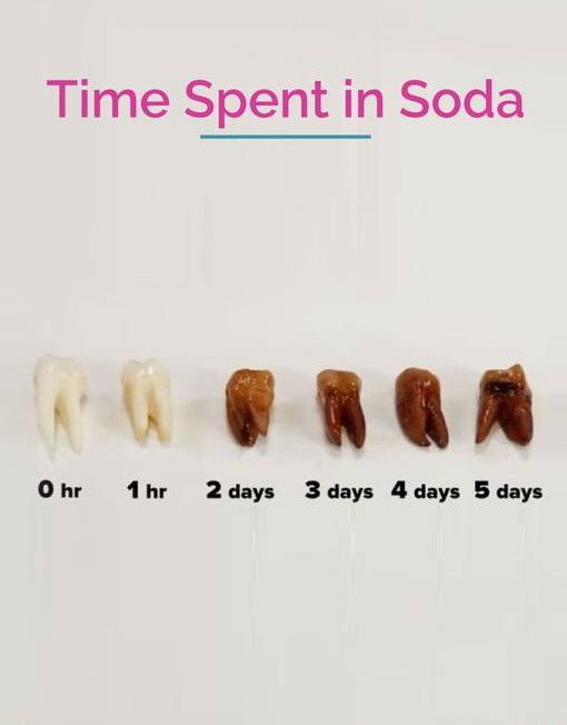 Teeth in soda acid